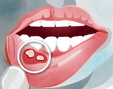 How to Get Rid of Canker Sores Naturally- treatment at Martinsville Family Dentistry  