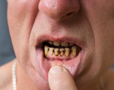 Meth Mouth: How Methamphetamine Use Affects Dental Health- treatment at Martinsville Family Dentistry  