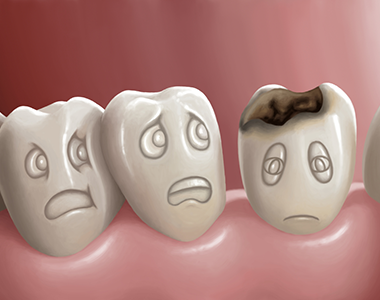 Cavities, or tooth decay- treatment at Martinsville Family Dentistry  