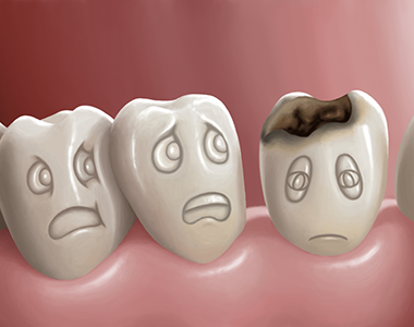 Cavities, or tooth decay- treatment at Martinsville Family Dentistry