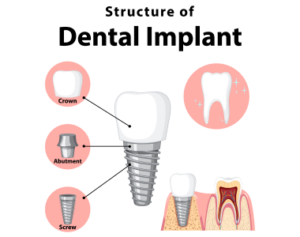 dental implants Martinsville VA