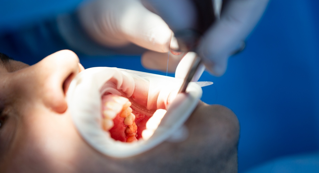 Dental sealants Image