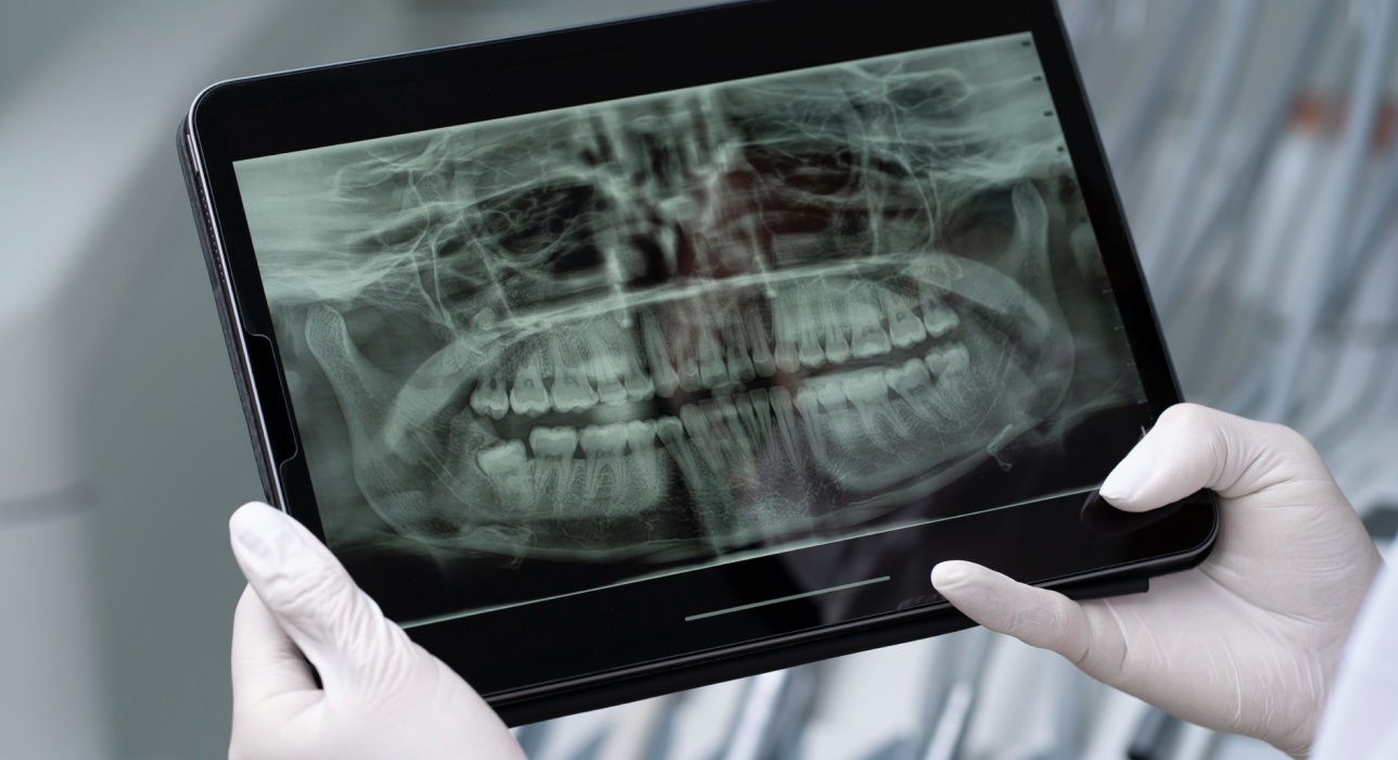 Digital Xrays Image