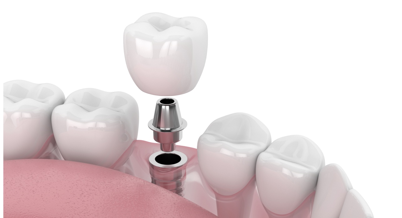 Single Implants Image