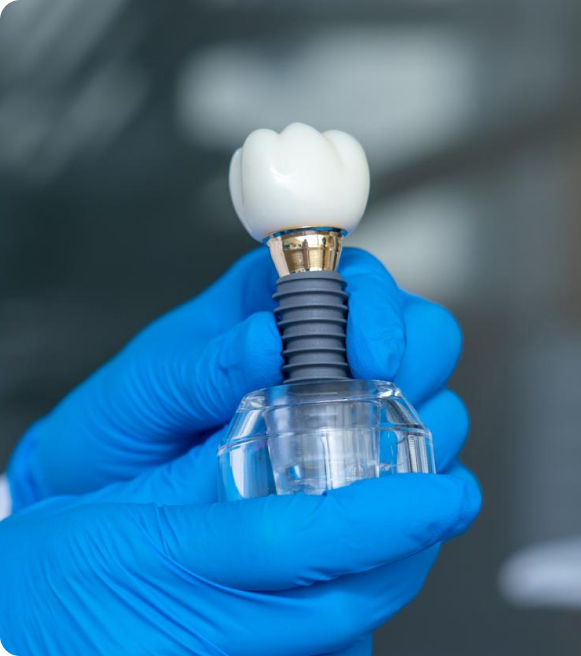 Implant and Smiles